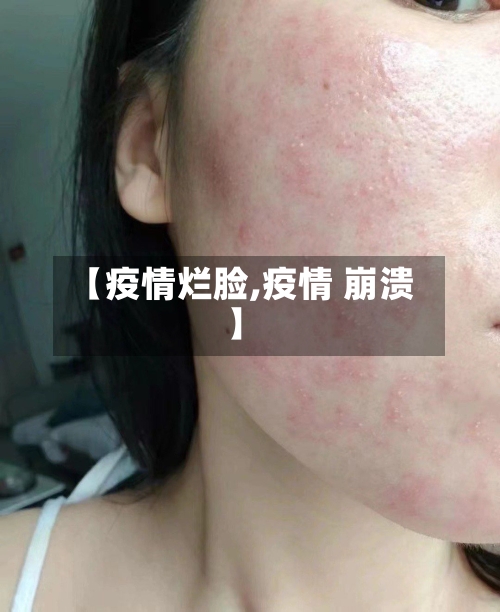 【疫情烂脸,疫情 崩溃】-第2张图片