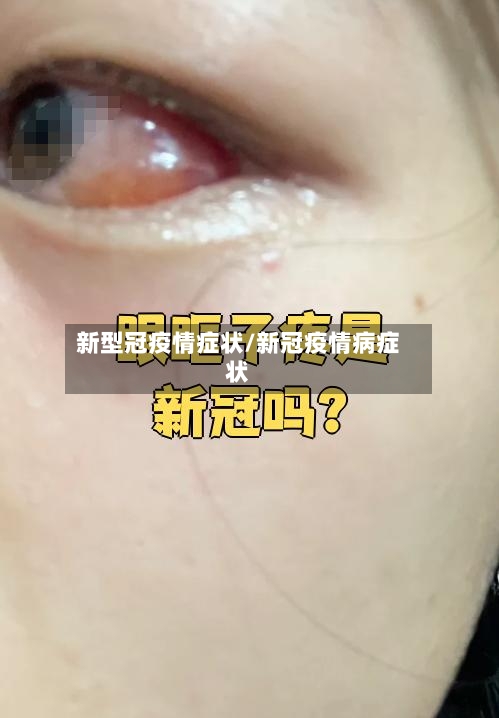 新型冠疫情症状/新冠疫情病症状