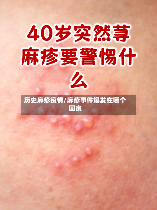 历史麻疹疫情/麻疹事件爆发在哪个国家-第2张图片