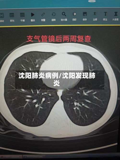 沈阳肺炎病例/沈阳发现肺炎